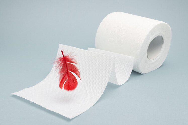 La sangre en el papel higiénico es un signo de hemorroides